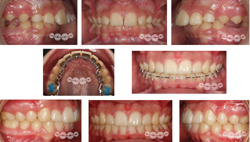 Ortodontia Lingual em Adolescentes