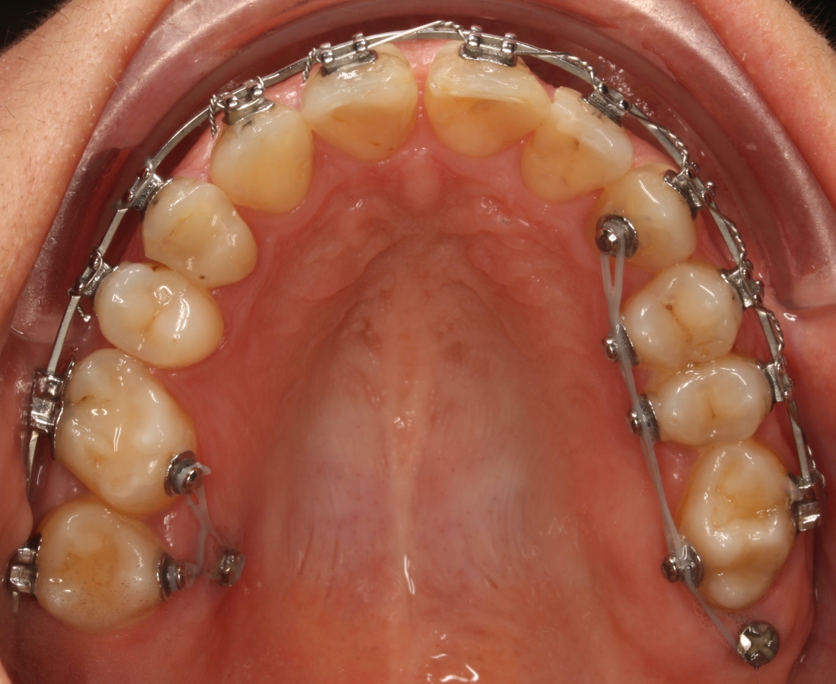 Importância dos microimplantes