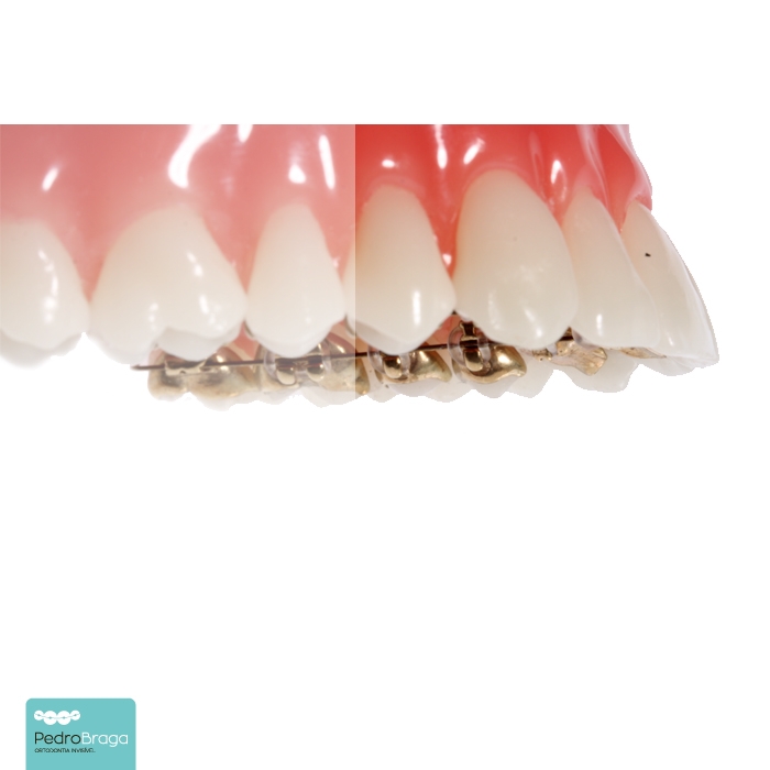 Ortodontia Lingual é para todos os casos?