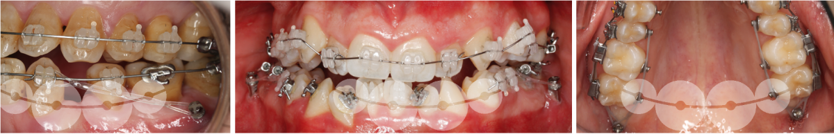 O que são MICROIMPLANTES?
