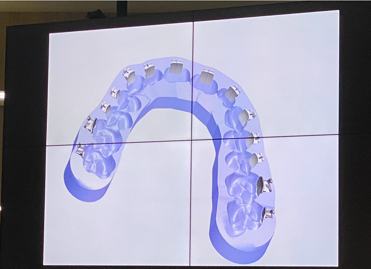 A precisão da colocação de um aparelho dentário é fundamental?
