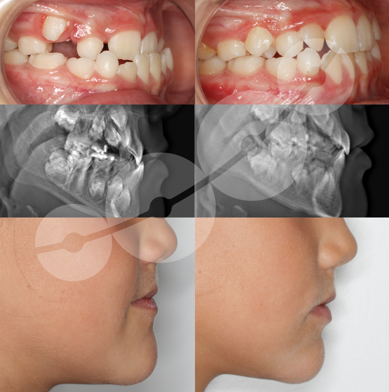 MODIFICAÇÃO DO CRESCIMENTO CRANÊO-FACIAL