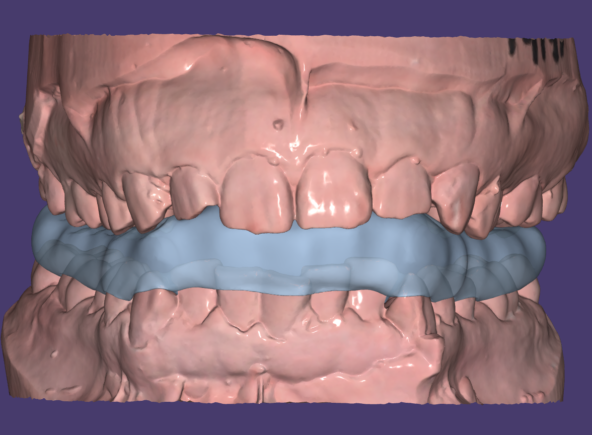 Aparelho Dentário com Problemas Articulares?